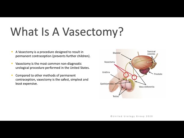 Vasectomy United Urology